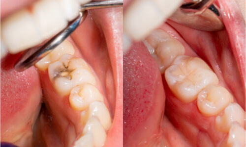 How Much Is A Dental Filling? Is It Covered By Dental How Much Is A Dental Filling? Is It Covered By Dental