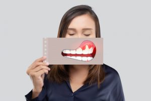 Bleeding Gums and Liver Disease swelling